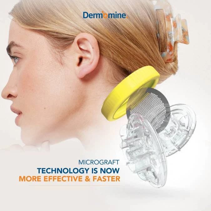 Stem Cell Hair Micrograft