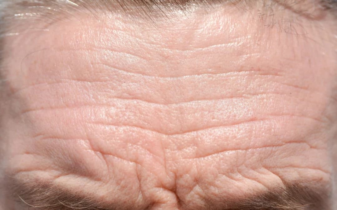 Anti-wrinkle treatment