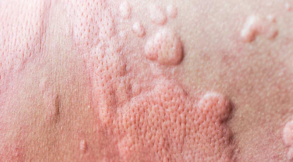 Allergy Test