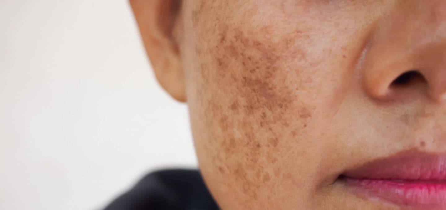 Pigmentation Treatment